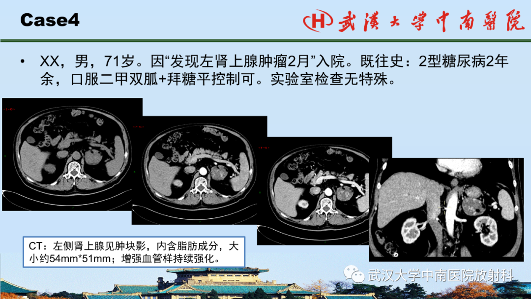 影像PPT - 【PPT】腹盆病例讨论（肾上腺）-24