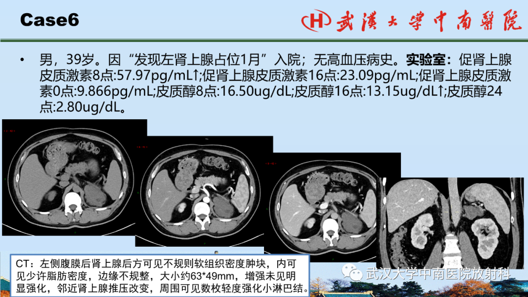 影像PPT - 【PPT】腹盆病例讨论（肾上腺）-28