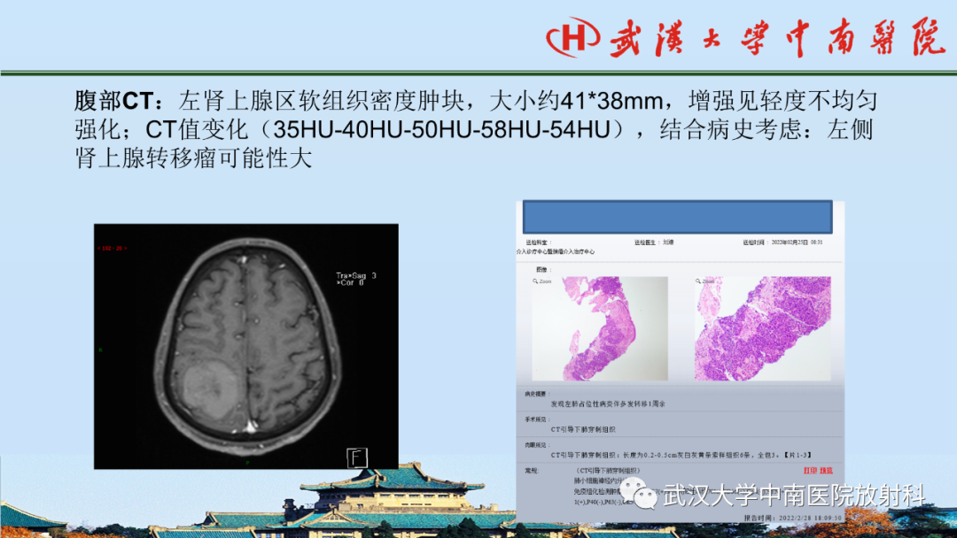 影像PPT - 【PPT】腹盆病例讨论（肾上腺）-23