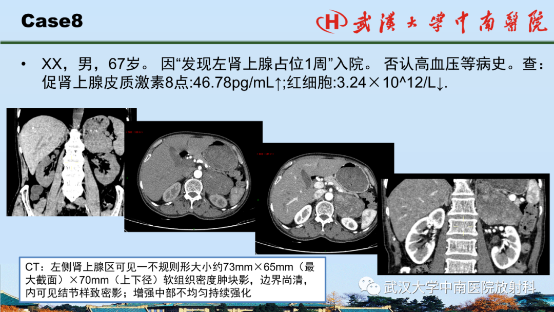 影像PPT - 【PPT】腹盆病例讨论（肾上腺）-31