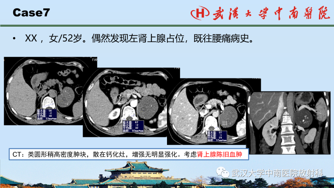 影像PPT - 【PPT】腹盆病例讨论（肾上腺）-30