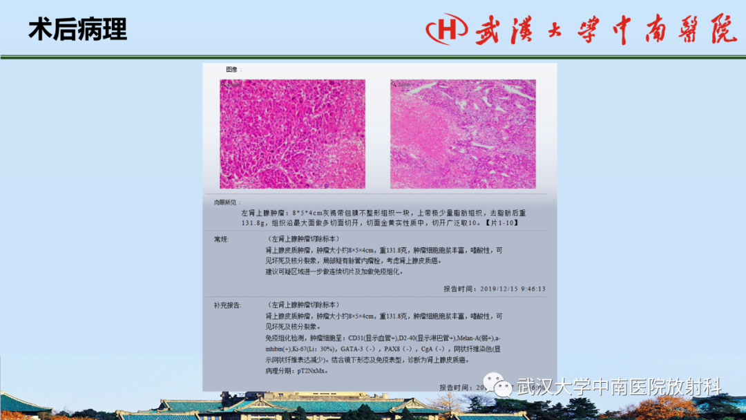 影像PPT - 【PPT】腹盆病例讨论（肾上腺）-32