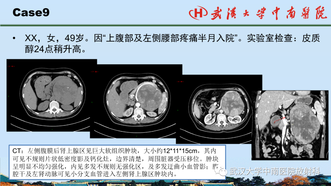 影像PPT - 【PPT】腹盆病例讨论（肾上腺）-33