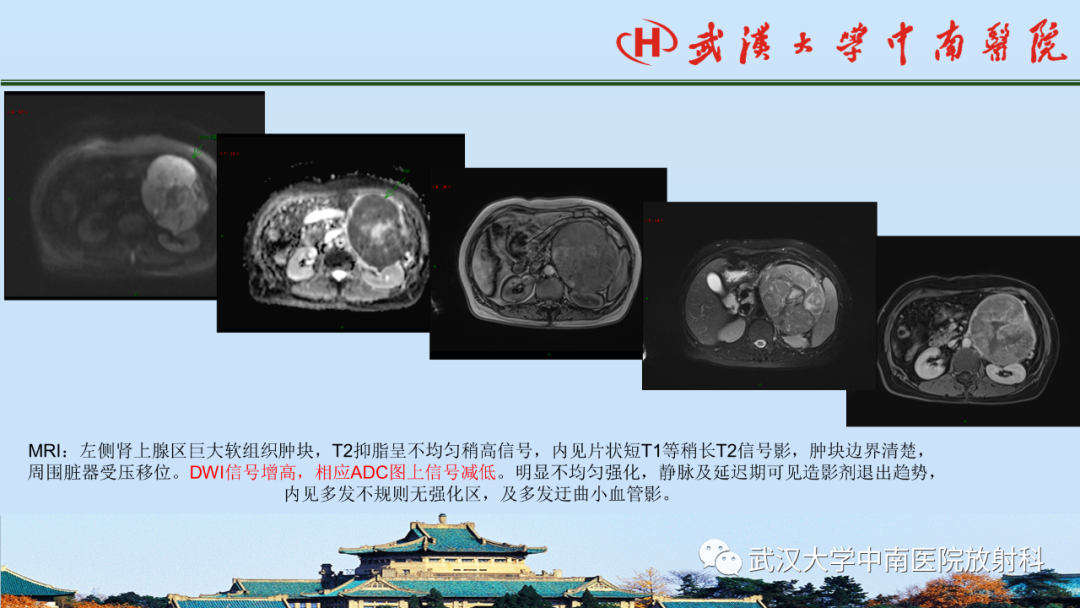 影像PPT - 【PPT】腹盆病例讨论（肾上腺）-34