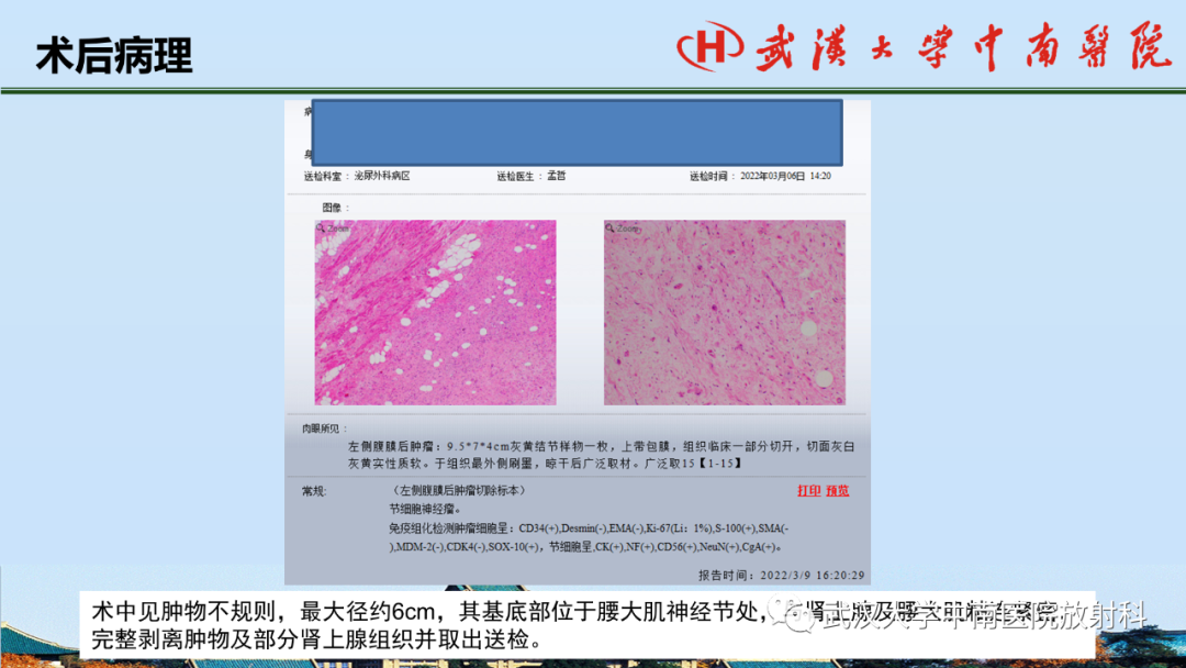 影像PPT - 【PPT】腹盆病例讨论（肾上腺）-29