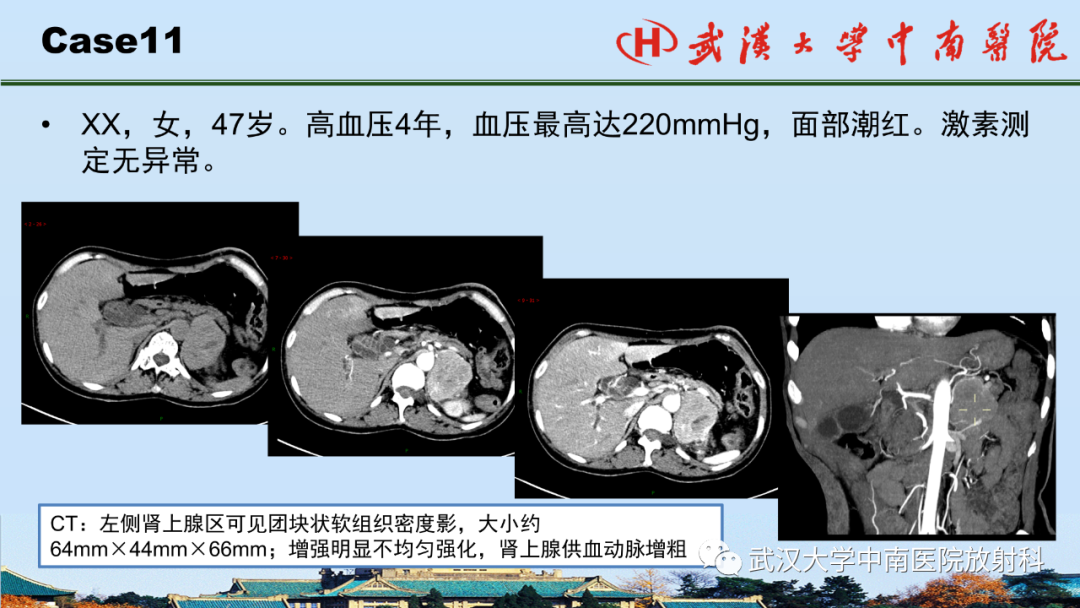 影像PPT - 【PPT】腹盆病例讨论（肾上腺）-38