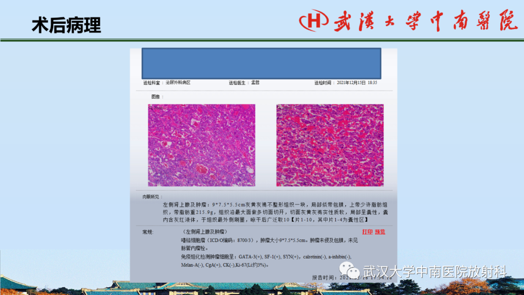 影像PPT - 【PPT】腹盆病例讨论（肾上腺）-39