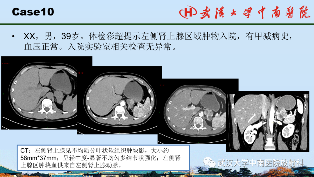 影像PPT - 【PPT】腹盆病例讨论（肾上腺）-36