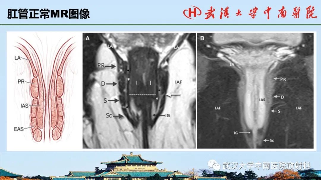 影像PPT - 【PPT】肛瘘的MRI成像与诊断-8