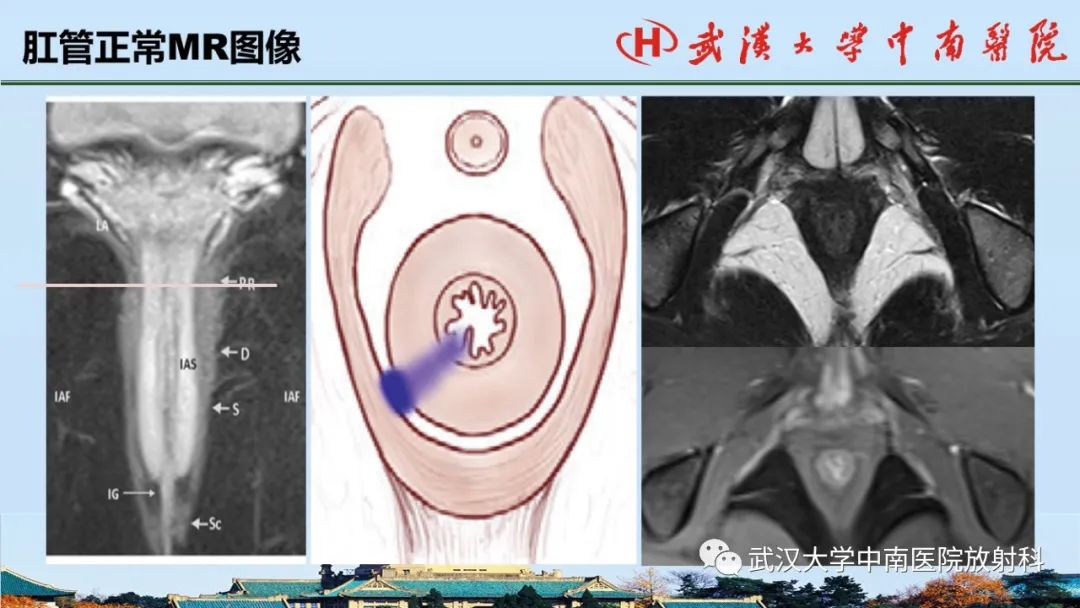 影像PPT - 【PPT】肛瘘的MRI成像与诊断-9
