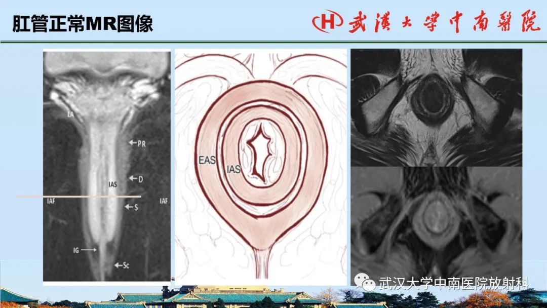 影像PPT - 【PPT】肛瘘的MRI成像与诊断-10