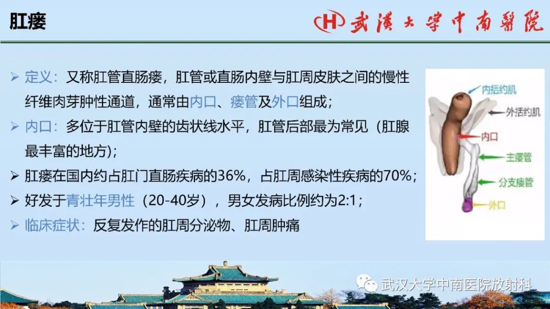 影像PPT - 【PPT】肛瘘的MRI成像与诊断-12