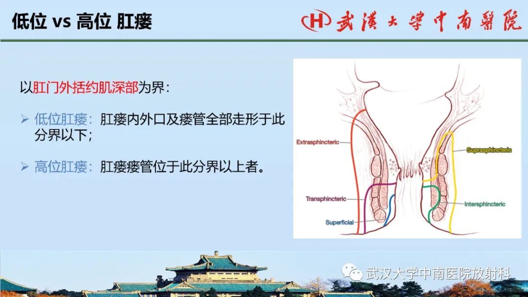 影像PPT - 【PPT】肛瘘的MRI成像与诊断-15