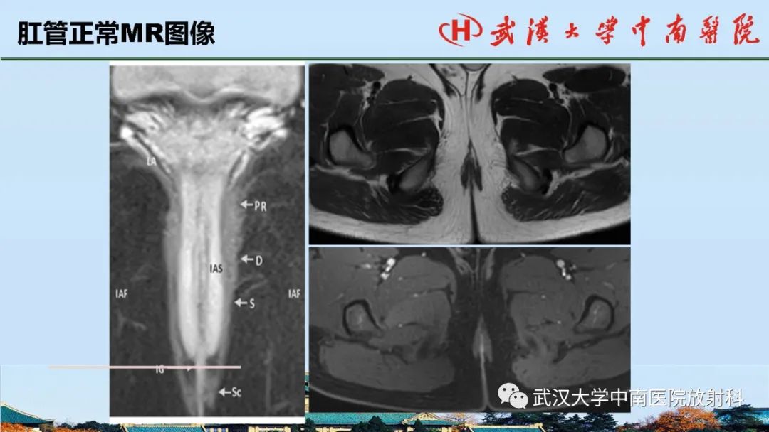 影像PPT - 【PPT】肛瘘的MRI成像与诊断-11