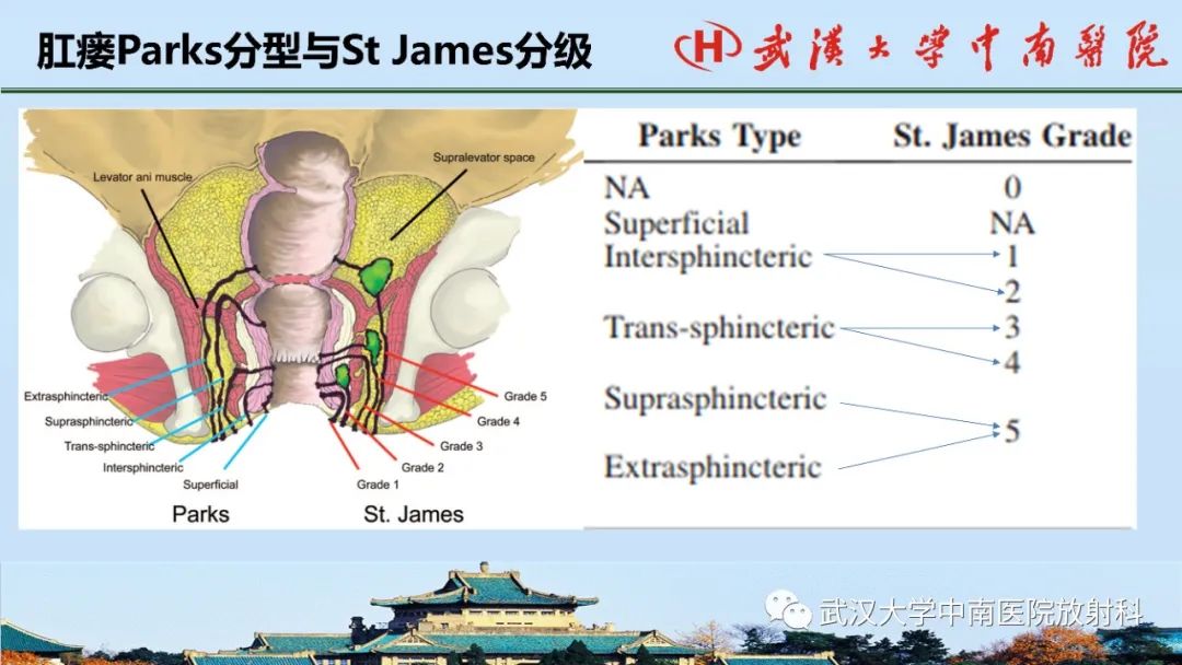 影像PPT - 【PPT】肛瘘的MRI成像与诊断-18