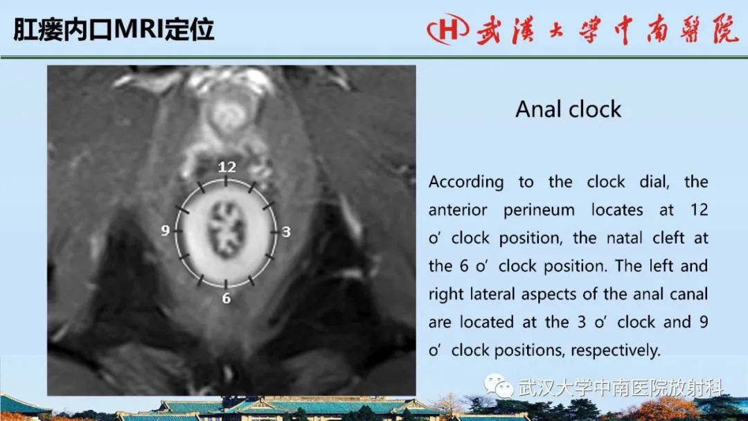 影像PPT - 【PPT】肛瘘的MRI成像与诊断-25
