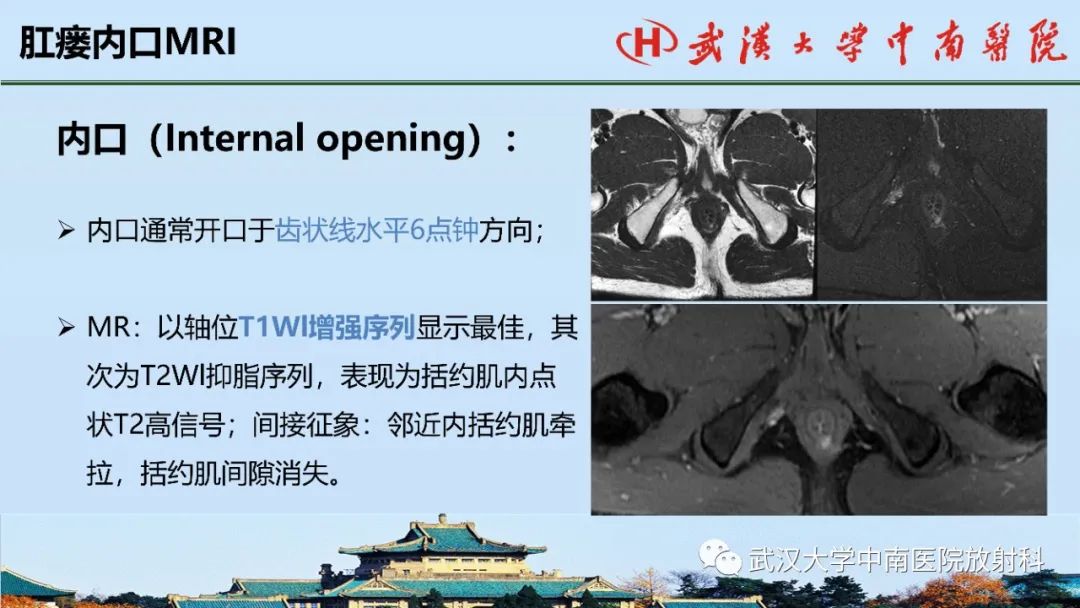 影像PPT - 【PPT】肛瘘的MRI成像与诊断-26