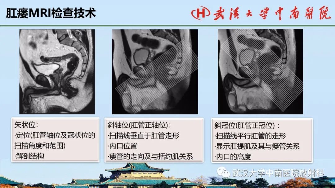 影像PPT - 【PPT】肛瘘的MRI成像与诊断-22
