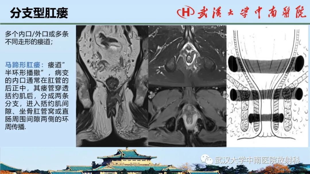 影像PPT - 【PPT】肛瘘的MRI成像与诊断-28