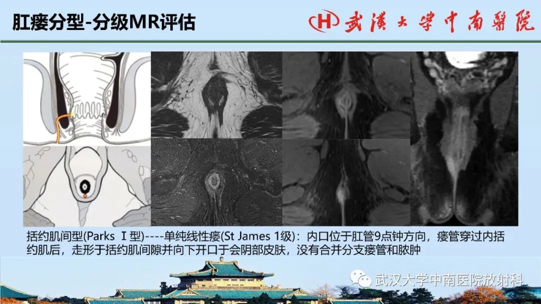 影像PPT - 【PPT】肛瘘的MRI成像与诊断-29
