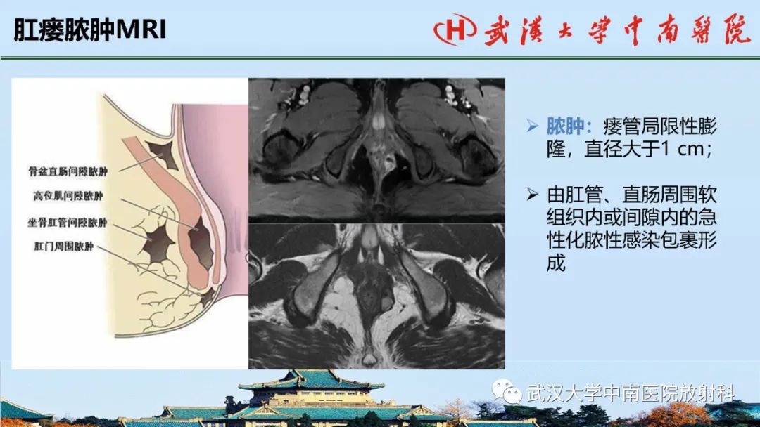 影像PPT - 【PPT】肛瘘的MRI成像与诊断-27