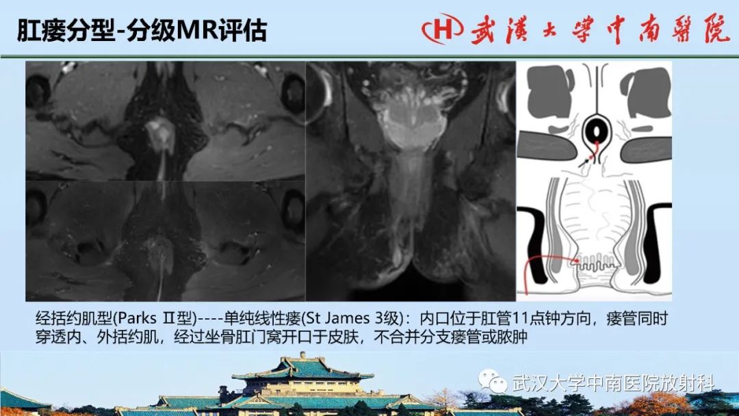 影像PPT - 【PPT】肛瘘的MRI成像与诊断-32