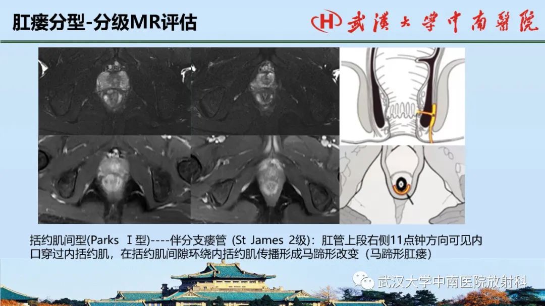 影像PPT - 【PPT】肛瘘的MRI成像与诊断-30