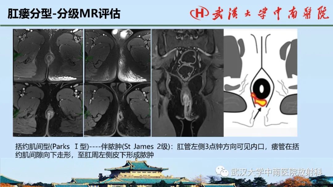 影像PPT - 【PPT】肛瘘的MRI成像与诊断-31