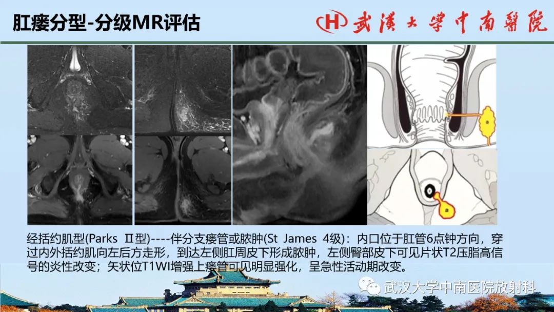 影像PPT - 【PPT】肛瘘的MRI成像与诊断-33