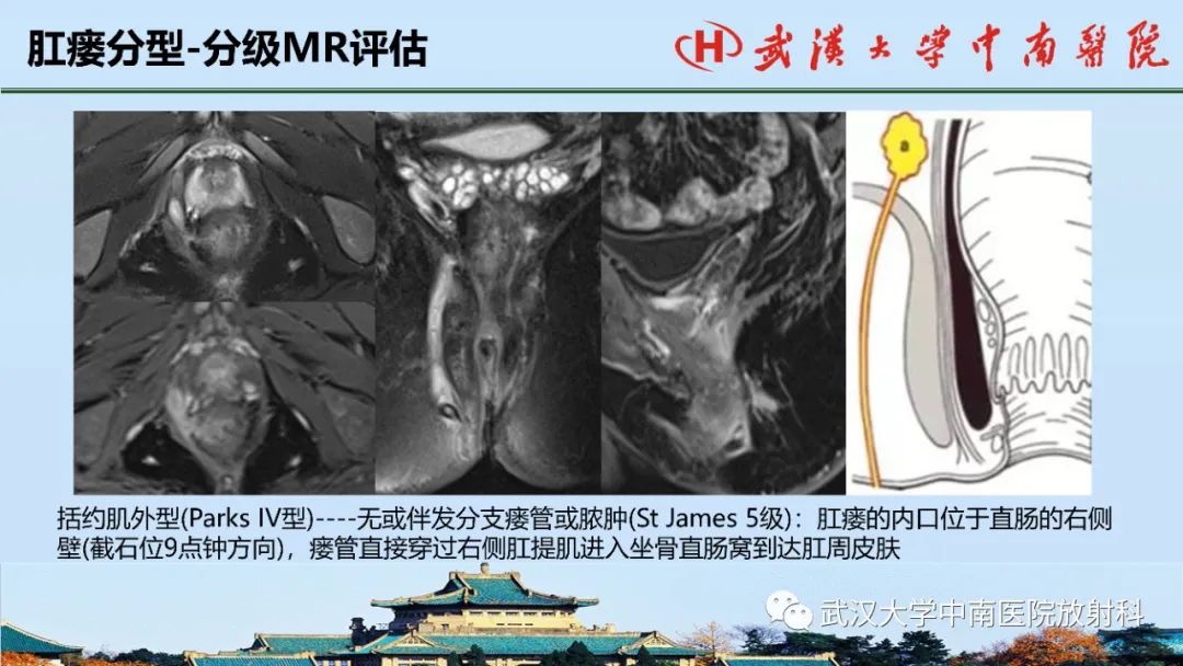 影像PPT - 【PPT】肛瘘的MRI成像与诊断-35