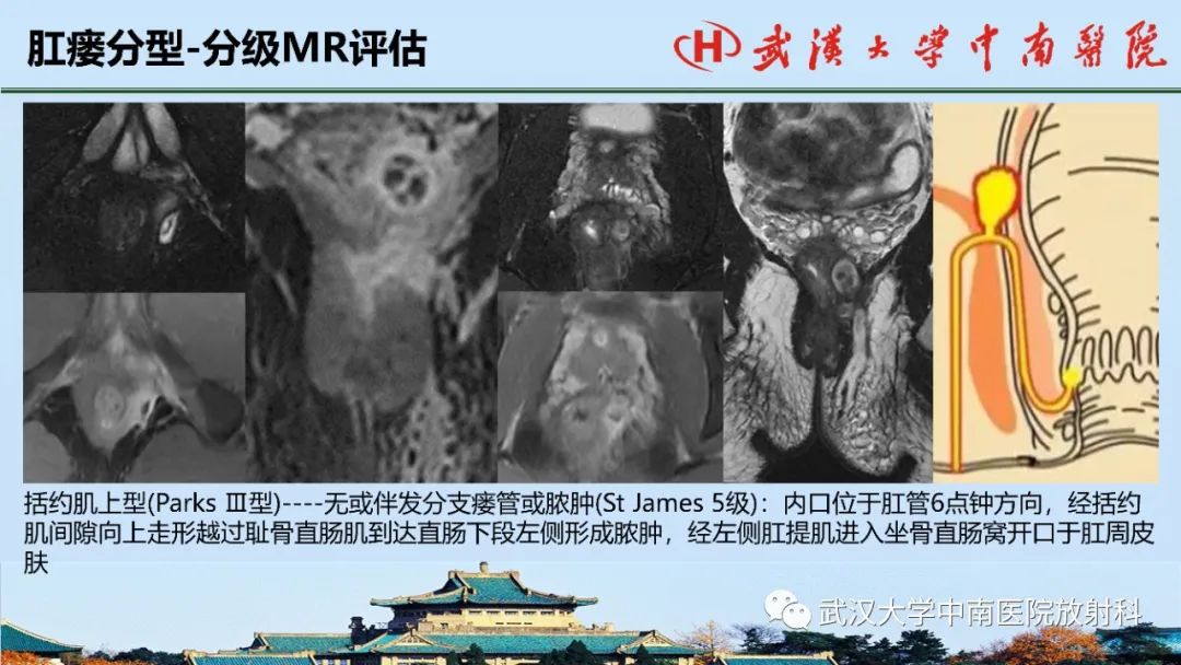 影像PPT - 【PPT】肛瘘的MRI成像与诊断-34