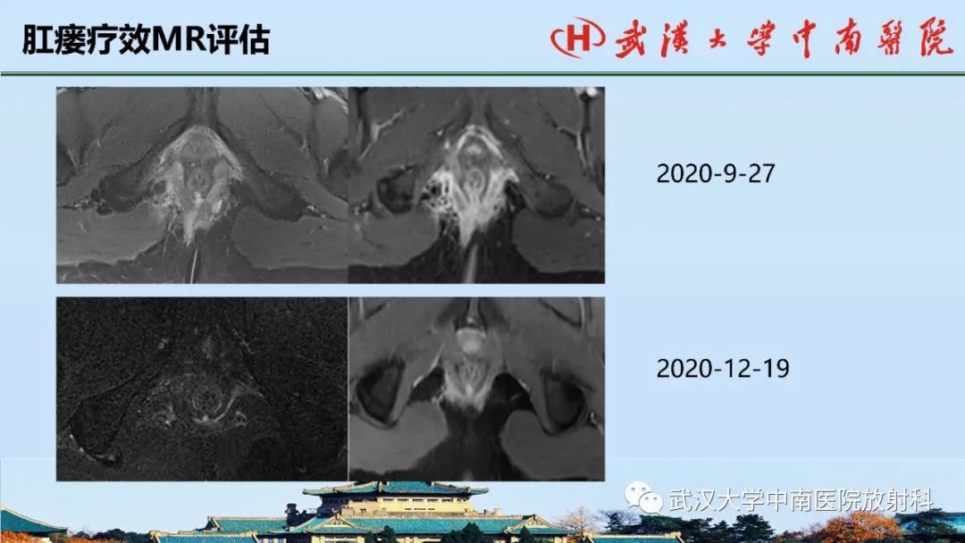 影像PPT - 【PPT】肛瘘的MRI成像与诊断-36