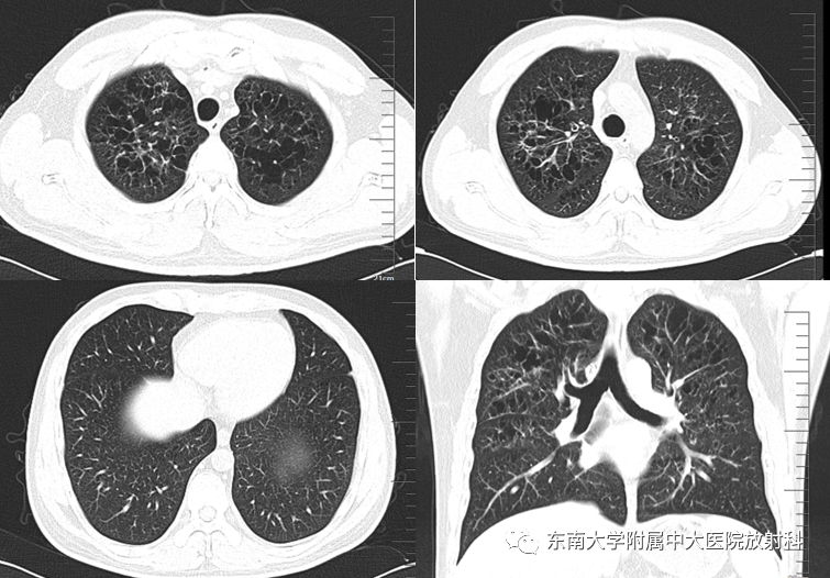 影像PPT - 【PPT】朗格汉斯细胞组织细胞增生症-1 影像PPT - 【PPT】朗格汉斯细胞组织细胞增生症-1