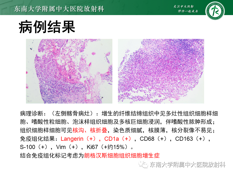 影像PPT - 【PPT】朗格汉斯细胞组织细胞增生症-3 影像PPT - 【PPT】朗格汉斯细胞组织细胞增生症-3