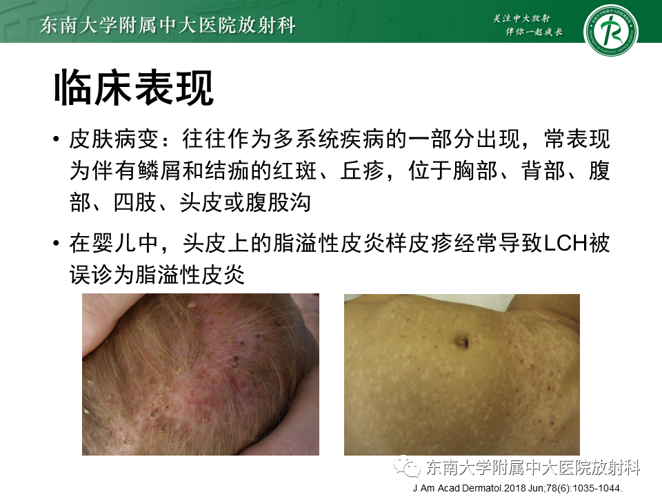 影像PPT - 【PPT】朗格汉斯细胞组织细胞增生症-7 影像PPT - 【PPT】朗格汉斯细胞组织细胞增生症-7