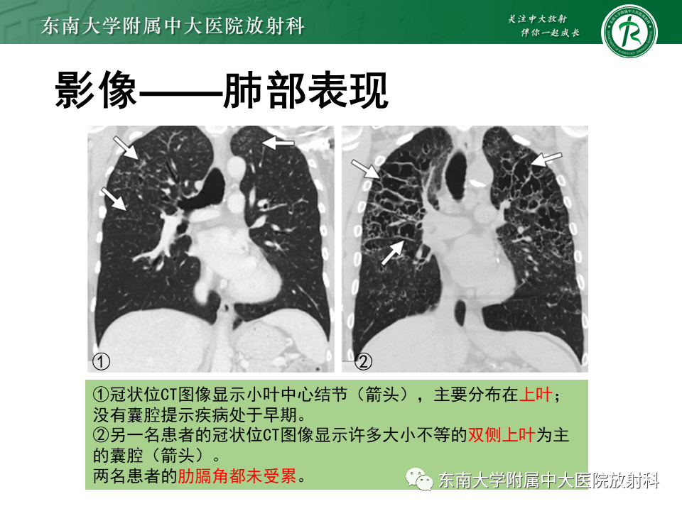 影像PPT - 【PPT】朗格汉斯细胞组织细胞增生症-13 影像PPT - 【PPT】朗格汉斯细胞组织细胞增生症-13