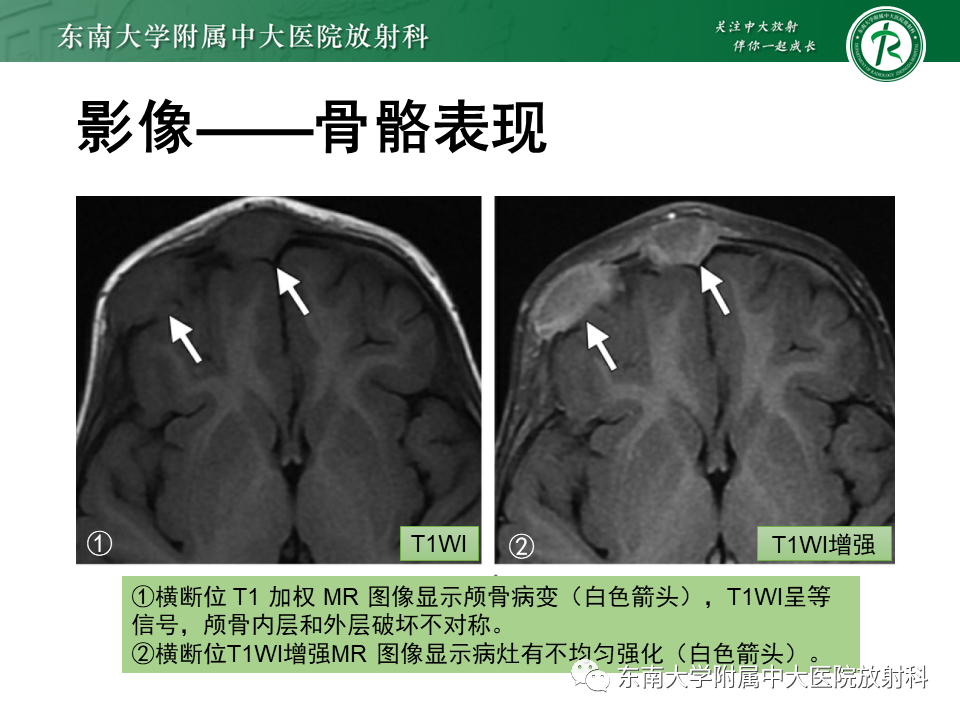 影像PPT - 【PPT】朗格汉斯细胞组织细胞增生症-16 影像PPT - 【PPT】朗格汉斯细胞组织细胞增生症-16