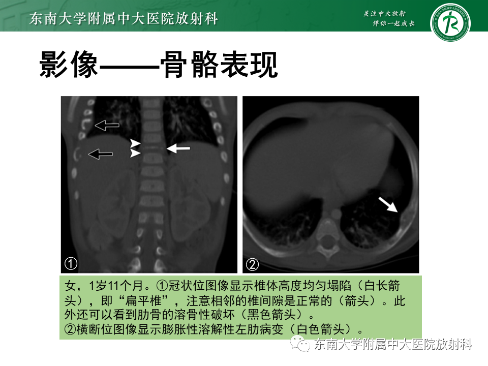 影像PPT - 【PPT】朗格汉斯细胞组织细胞增生症-18 影像PPT - 【PPT】朗格汉斯细胞组织细胞增生症-18
