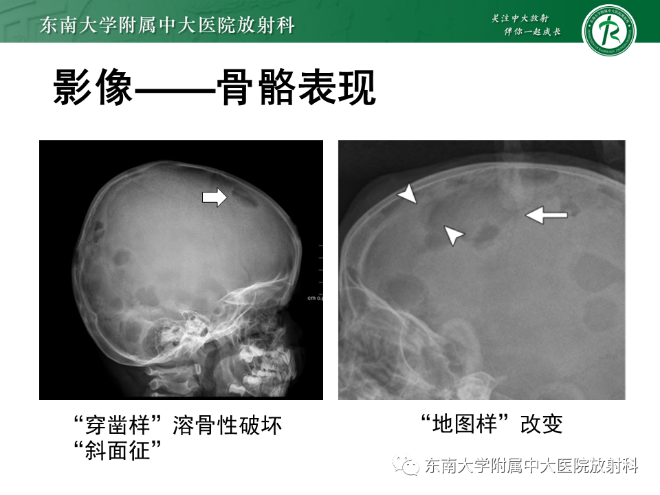影像PPT - 【PPT】朗格汉斯细胞组织细胞增生症-15 影像PPT - 【PPT】朗格汉斯细胞组织细胞增生症-15