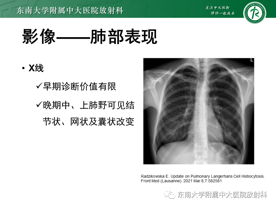 影像PPT - 【PPT】朗格汉斯细胞组织细胞增生症-11 影像PPT - 【PPT】朗格汉斯细胞组织细胞增生症-11