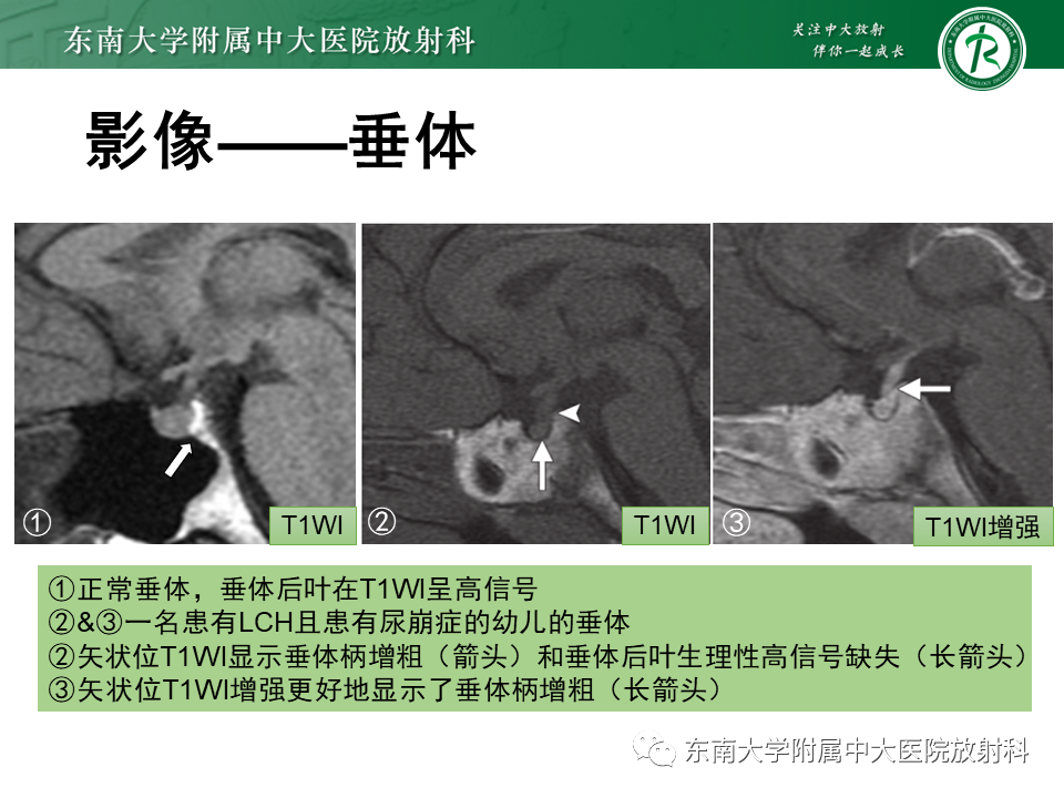 影像PPT - 【PPT】朗格汉斯细胞组织细胞增生症-21 影像PPT - 【PPT】朗格汉斯细胞组织细胞增生症-21