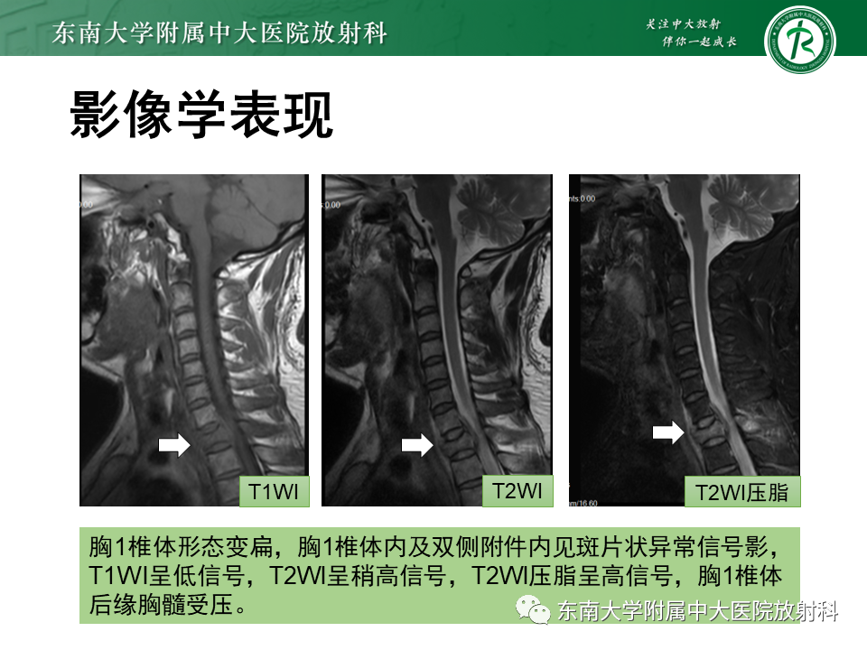 影像PPT - 【PPT】朗格汉斯细胞组织细胞增生症-19 影像PPT - 【PPT】朗格汉斯细胞组织细胞增生症-19
