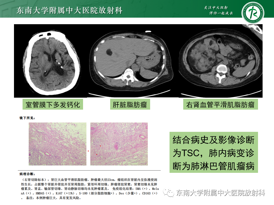 影像PPT - 【PPT】朗格汉斯细胞组织细胞增生症-24 影像PPT - 【PPT】朗格汉斯细胞组织细胞增生症-24