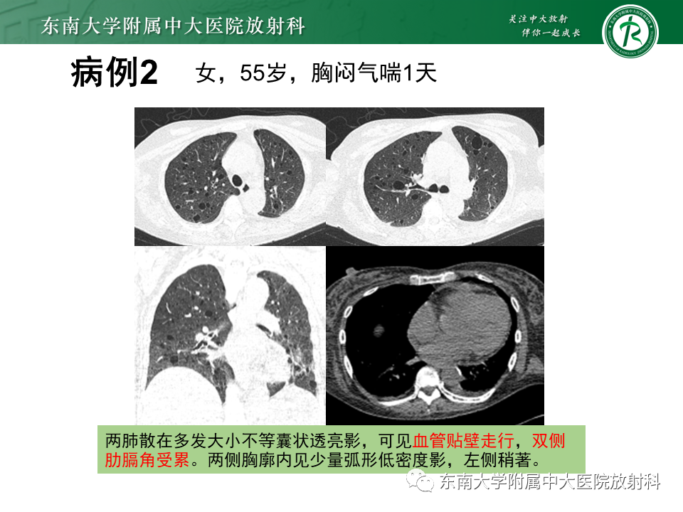 影像PPT - 【PPT】朗格汉斯细胞组织细胞增生症-23 影像PPT - 【PPT】朗格汉斯细胞组织细胞增生症-23