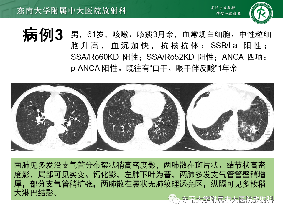 影像PPT - 【PPT】朗格汉斯细胞组织细胞增生症-26 影像PPT - 【PPT】朗格汉斯细胞组织细胞增生症-26