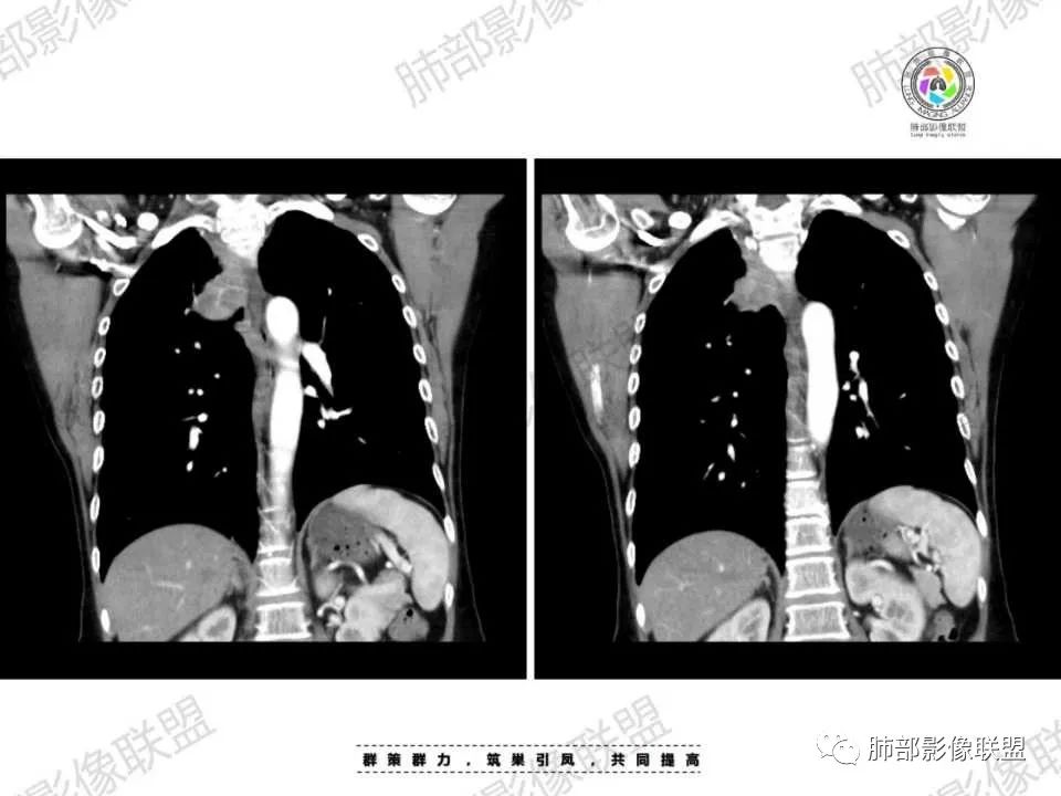 影像PPT - 【病例】胸椎旁病变伴骨破坏,肺内还是肺外?恶性还是良性?-31 影像PPT - 【病例】胸椎旁病变伴骨破坏,肺内还是肺外?恶性还是良性?-31