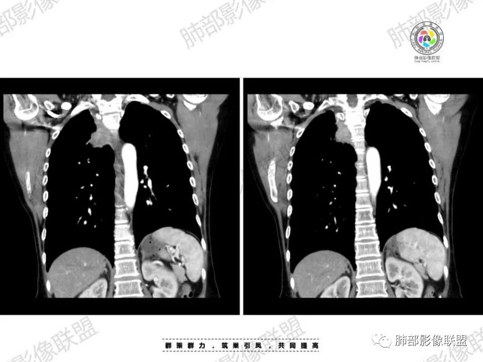 影像PPT - 【病例】胸椎旁病变伴骨破坏,肺内还是肺外?恶性还是良性?-32 影像PPT - 【病例】胸椎旁病变伴骨破坏,肺内还是肺外?恶性还是良性?-32