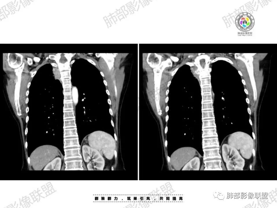 影像PPT - 【病例】胸椎旁病变伴骨破坏,肺内还是肺外?恶性还是良性?-33 影像PPT - 【病例】胸椎旁病变伴骨破坏,肺内还是肺外?恶性还是良性?-33