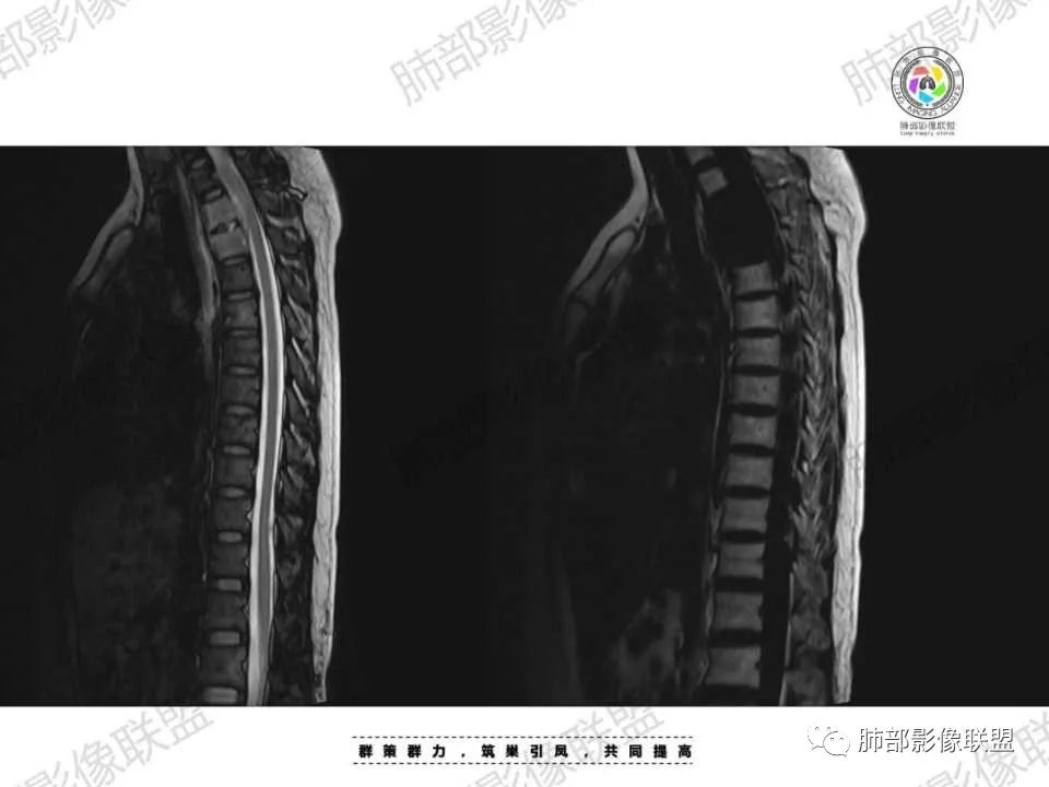 影像PPT - 【病例】胸椎旁病变伴骨破坏,肺内还是肺外?恶性还是良性?-34 影像PPT - 【病例】胸椎旁病变伴骨破坏,肺内还是肺外?恶性还是良性?-34