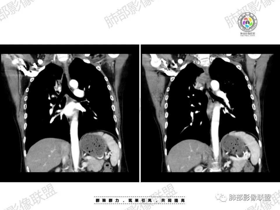 影像PPT - 【病例】胸椎旁病变伴骨破坏,肺内还是肺外?恶性还是良性?-30 影像PPT - 【病例】胸椎旁病变伴骨破坏,肺内还是肺外?恶性还是良性?-30
